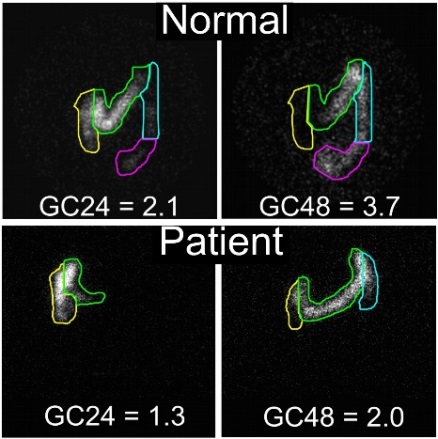 Normal colonic transit compared with colonic transit in a patient with A997T-NaV1.5 mutation from the Cellular and Molecular Physiology of Gastrointestinal Disorders Lab of Gianrico Farrugia, M.D.