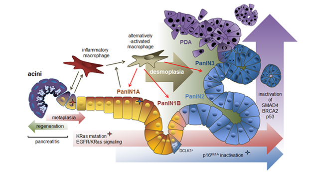 Image showing progression to pancreatic cancer