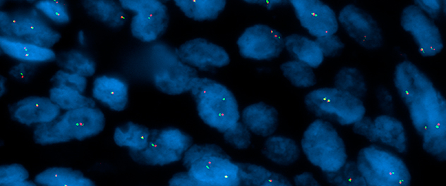 Fluorescence in situ hybridization (FISH) for catalytic subunit alpha of protein kinase A cAMP-activated (PRKACA) protein coding gene.