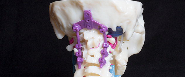 3D-printed device at the base of the skull and cervical spine of a model.