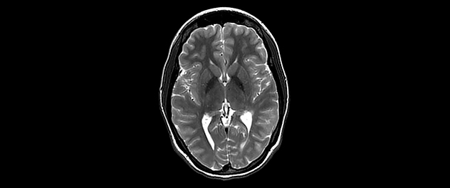 MRI studies of the basal ganglia level of the human brain are conducted by the Precision Medicine for Obesity Lab at Mayo Clinic to study appetite controls in the human brain.