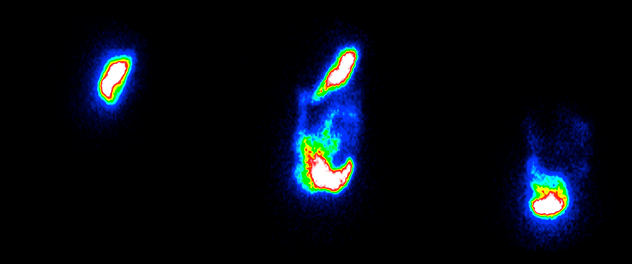 Gastric Emptying Scintigraphy. Dr. Acosta's lab is using abdominal scans obtained with a gamma-camera to evaluate how fast the stomach empties solids and liquid after radiolabeled meal ingestion.