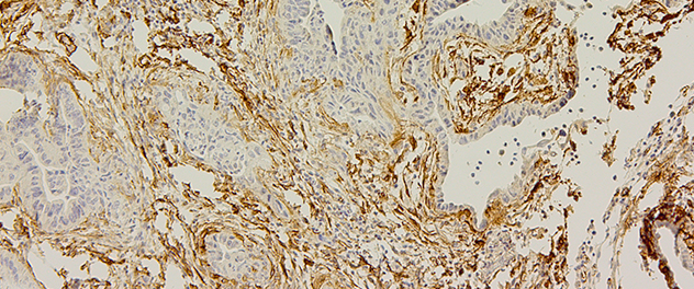 Image showing the tumor microenvironment in the Razidlo Cell Biology of Metastasis Lab