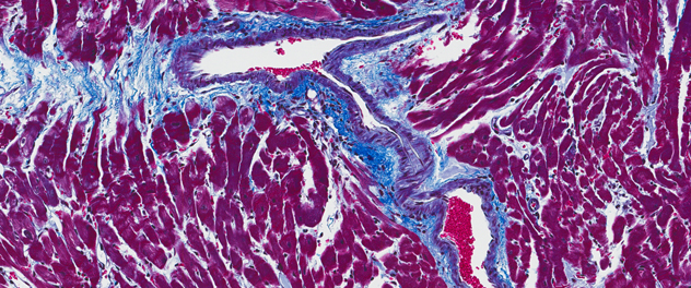 Microscopic fibrosis from Dr. Fairweather's lab at Mayo Clinic