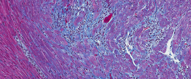 Microscopy image showing chronic myocarditis with fibrosis