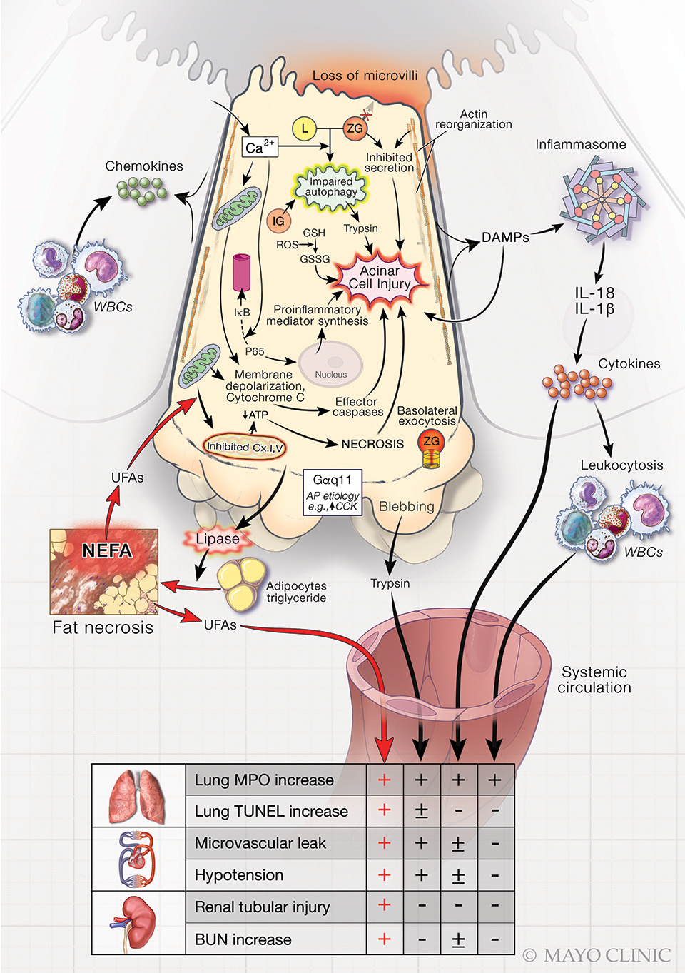 Image showing role of exocrine pancreas in systemic injury during acute pancreatitis from the Pancreatitis and Acute Outcomes Research Lab, led by Vijay P. Singh, M.B.B.S., at Mayo Clinic.