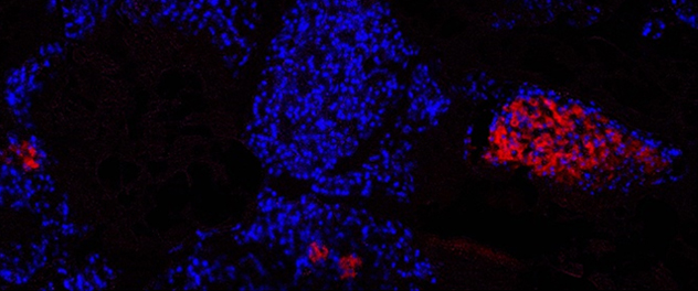 The uptake of near-infrared 2-deoxyglucose (NIR 2-DG) by the exocrine pancreas on a histologic section from severe glyceryl tri-linoleate (GTL) induced pancreatitis, the viable pancreas is shown as intact nuclei (blue) from the Pancreatitis and Acute Outcomes Lab, led by Vijay P. Singh, M.B.B.S., at Mayo Clinic.