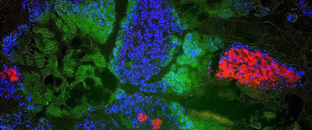 Islets, stained red for insulin, are spared from severe glyceryl tri-linoleate (GTL) induced pancreatitis from the Pancreatitis and Acute Outcomes Lab, led by Vijay P. Singh, M.B.B.S., at Mayo Clinic.