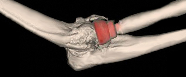 Showing use of radial head implants in an elbow.