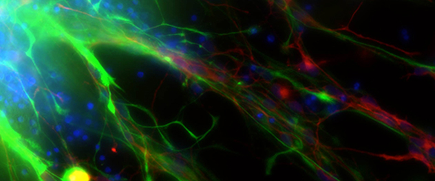 Brain tumor initiating cells have the ability to grow as spheres giving rise to multiple cell lineages.