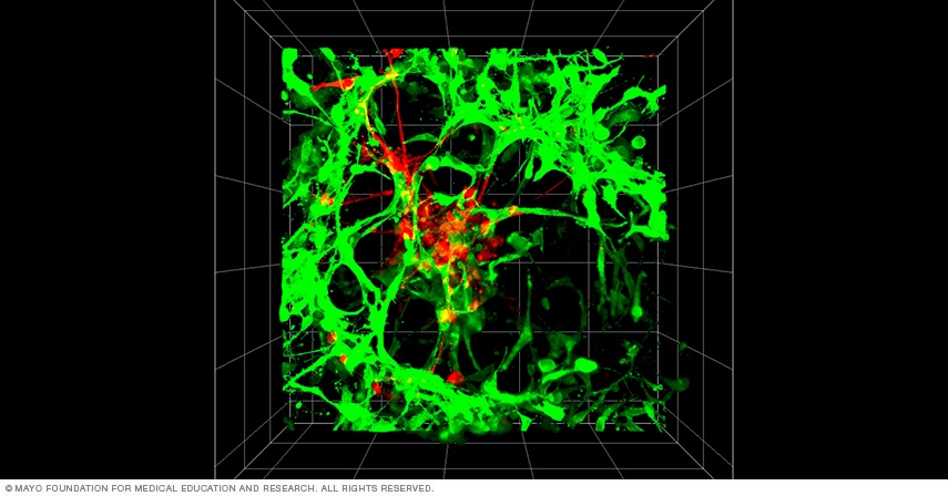 Microphotograph shows interaction of cultured brain tumor stem cells (BTSCs) and neural stem cells (NSCs).