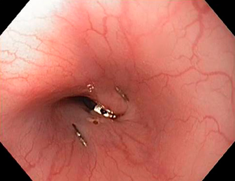 Endoscopic view of the augmented lower esophageal sphincter using a magnet closure device