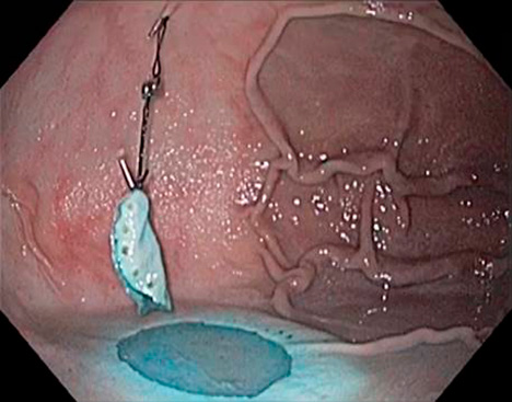 Large tissue resection in the stomach using a magnet traction device