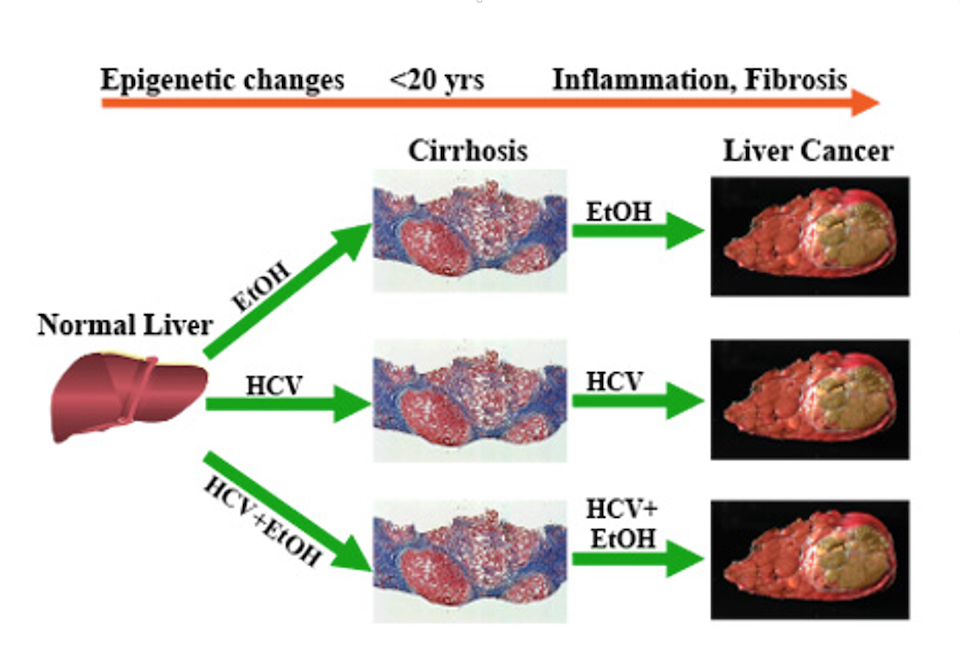 Elucidating how epigenetic changes in ethyl alcohol (EtOH) abuse and hepatitis C virus (HCV) infection impact the development and progression of liver disease