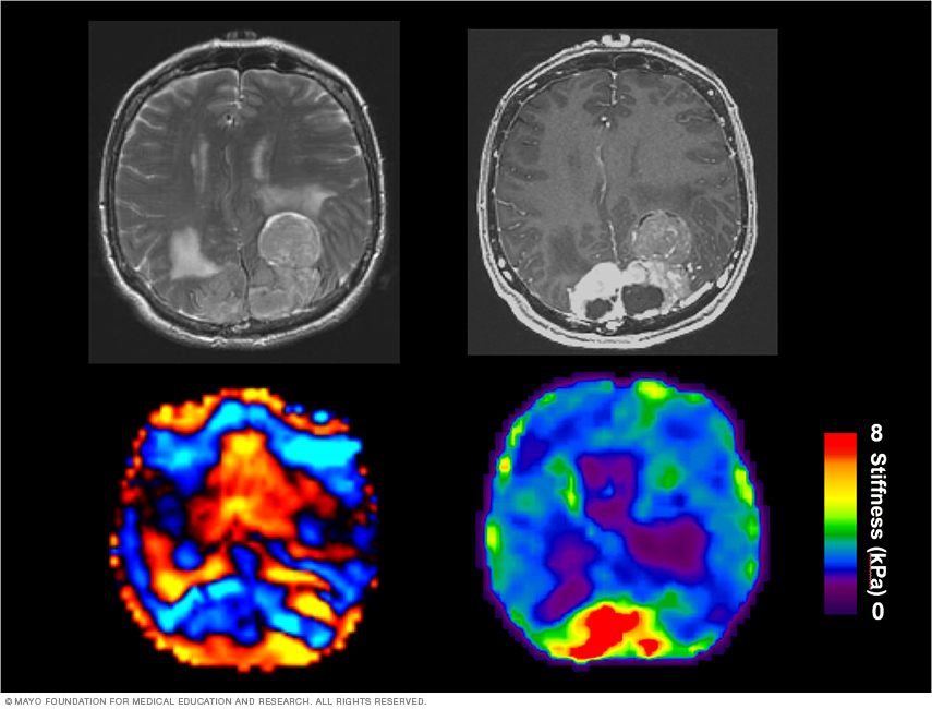 Brain glioblastoma distal from the lateral ventricle