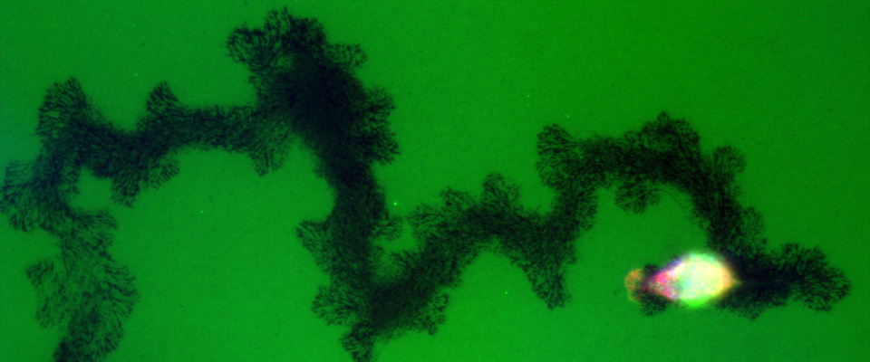 Microscopy showing degradation of the pancreatic extracellular matrix during metastasis