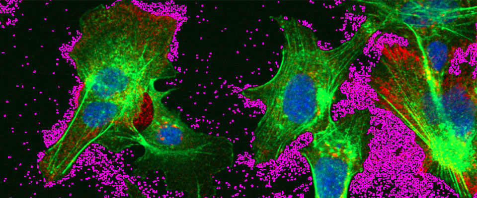 Microscopy showing hepatocytes infected with hepatitis B virus