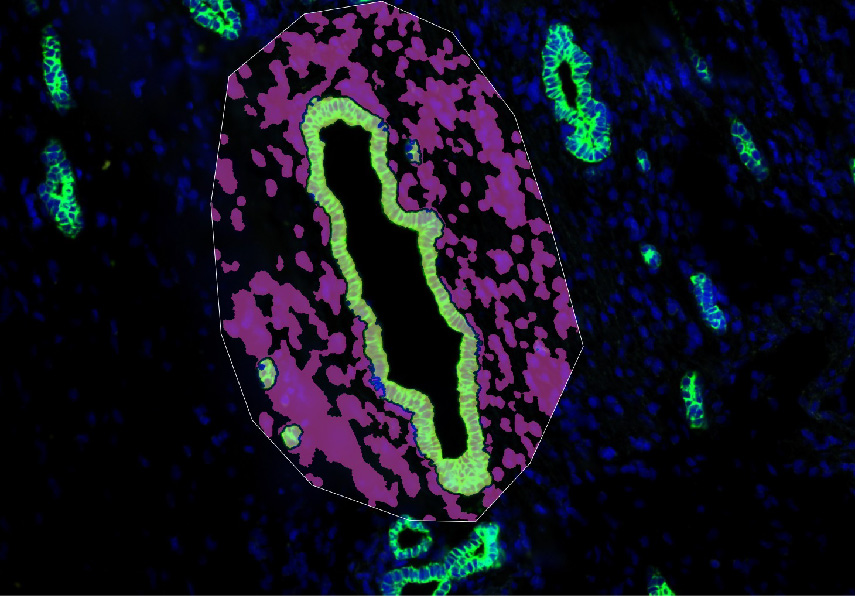 Image showing an example of spatial transcriptomics technology used on liver tissue from a patient with polycystic liver disease