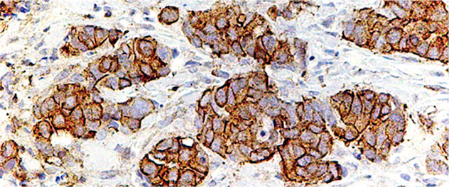 Microscopy of high-grade breast cancer tissue