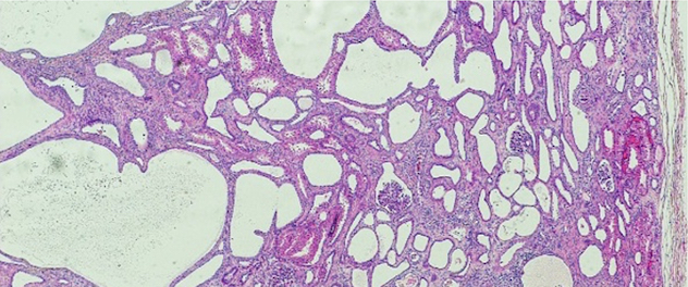 Microscopy showing polycystic kidney tissue